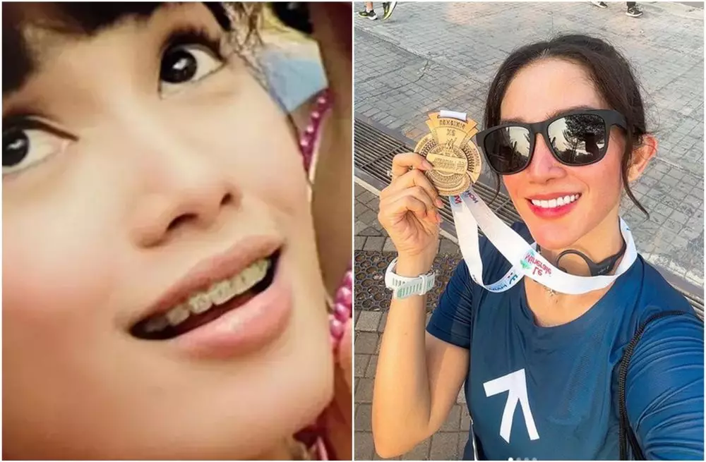 Transformasi penyanyi sebelum dan sesudah pasang behel berbagai sumber