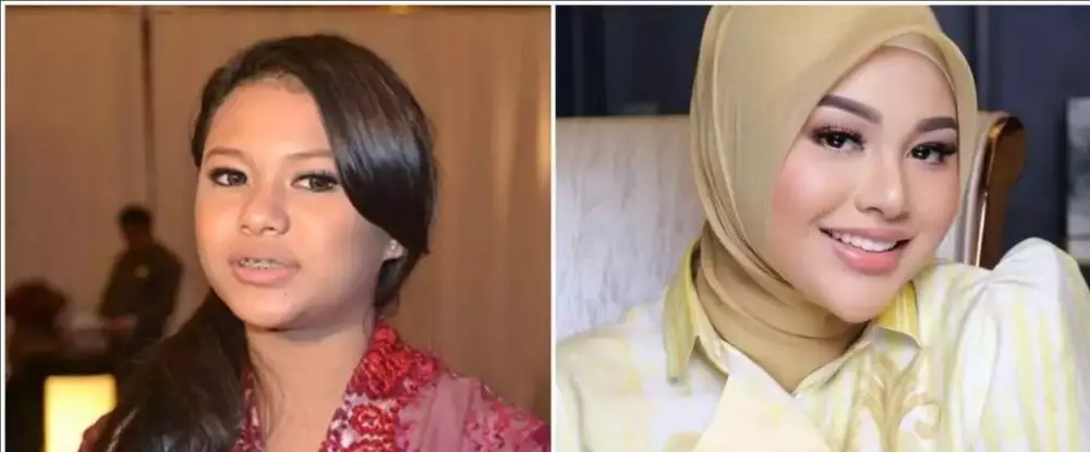 penyanyi veneer gigi © berbagai sumber penyanyi veneer gigi © berbagai sumber