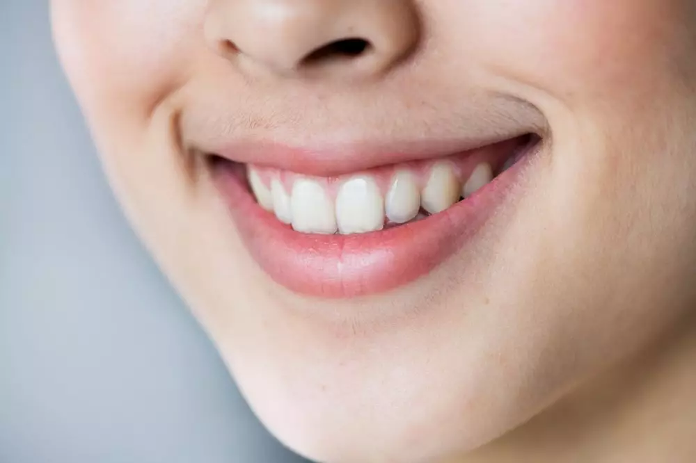 Jenis, efek samping, dan harga treatment veneer gigi Berbagai sumber Jenis, efek samping, dan harga treatment veneer gigi Berbagai sumber