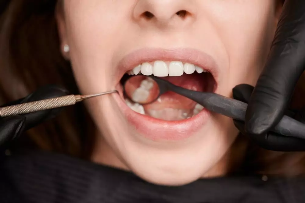 Jenis, efek samping, dan harga treatment veneer gigi Berbagai sumber Jenis, efek samping, dan harga treatment veneer gigi Berbagai sumber