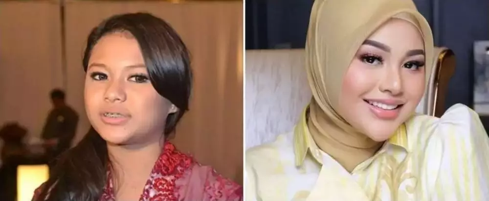 Potret 25 seleb sebelum & sesudah reparasi gigi Berbagai sumber