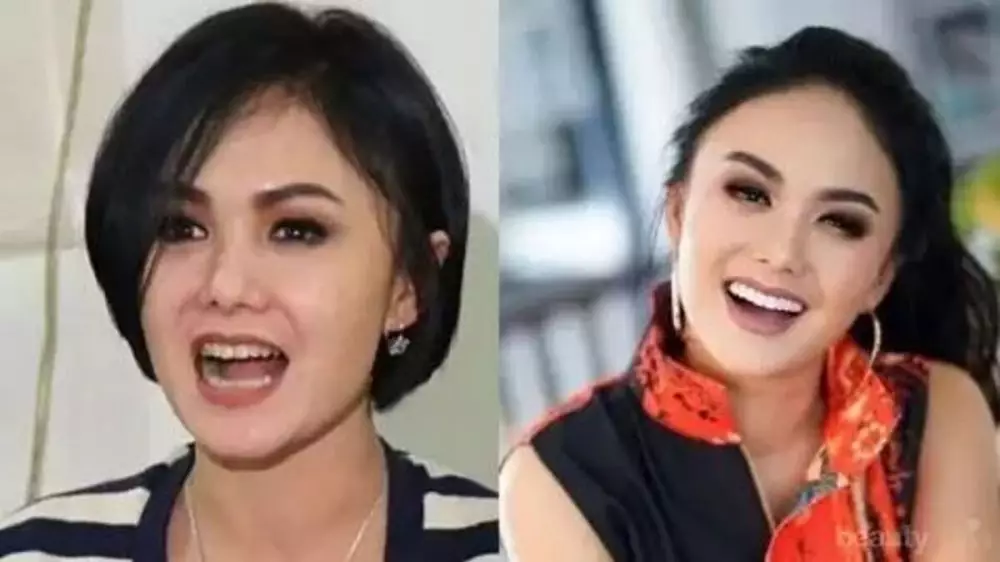 Potret 25 seleb sebelum & sesudah reparasi gigi Berbagai sumber