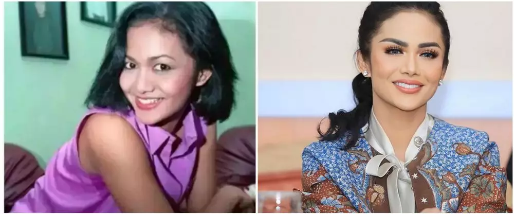 penyanyi suntik botoks. berbagai sumber