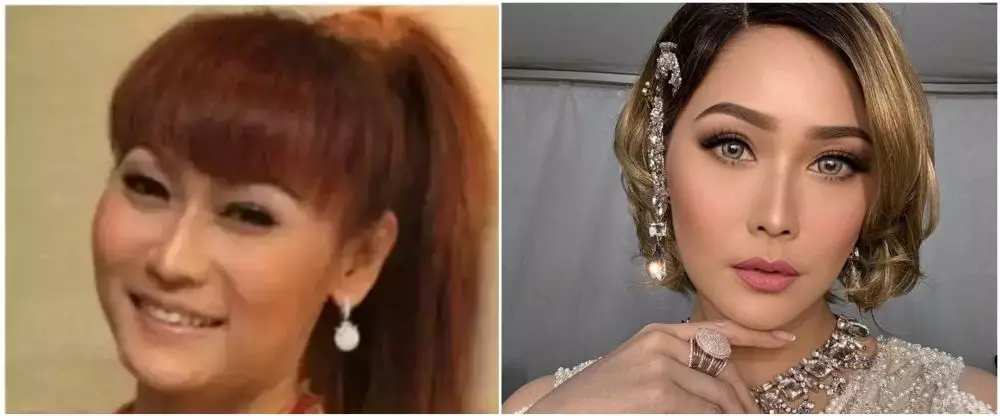 penyanyi suntik botoks. berbagai sumber