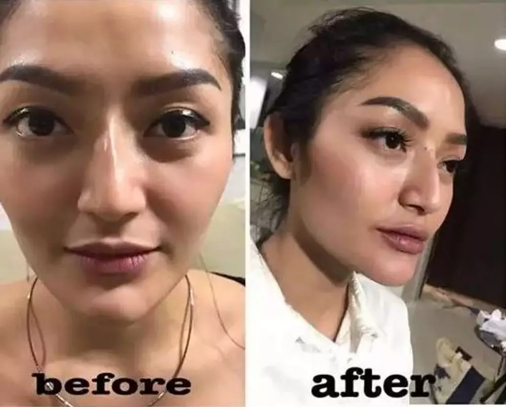 Potret seleb cewek sebelum dan sesudah lakukan filler dagu Berbagai sumber