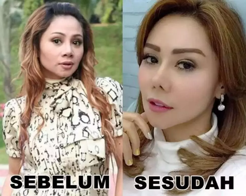 Potret seleb cewek sebelum dan sesudah lakukan filler dagu Berbagai sumber