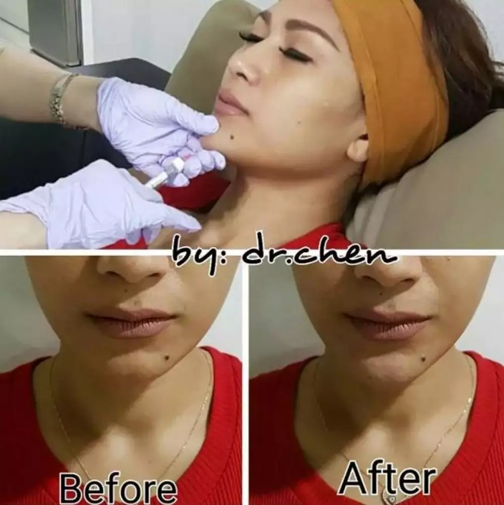 Potret seleb cewek sebelum dan sesudah lakukan filler dagu Berbagai sumber