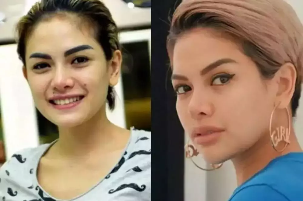 Potret seleb cewek sebelum dan sesudah lakukan filler dagu Berbagai sumber