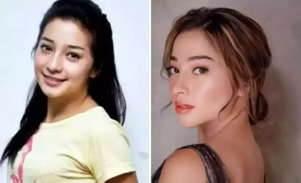 Potret seleb cewek sebelum dan sesudah lakukan filler dagu Berbagai sumber