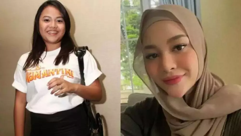 Potret seleb cewek sebelum dan sesudah lakukan filler dagu Berbagai sumber