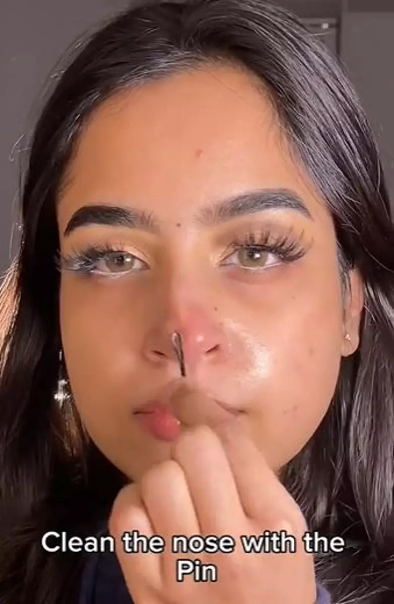 Jepit lidi hilangkan komedo di wajah Berbagai sumber Jepit lidi hilangkan komedo di wajah Berbagai sumber