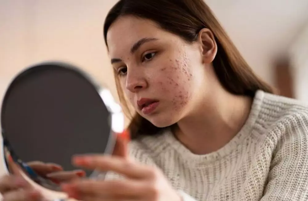 Beda purging dan breakout serta cara mengatasinya freepik.com