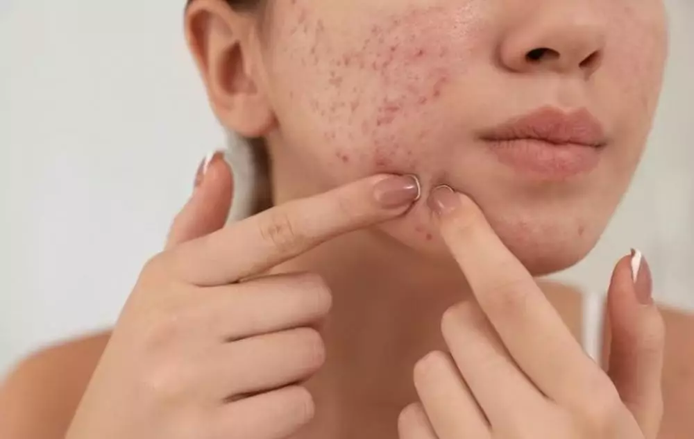 Beda purging dan breakout serta cara mengatasinya freepik.com