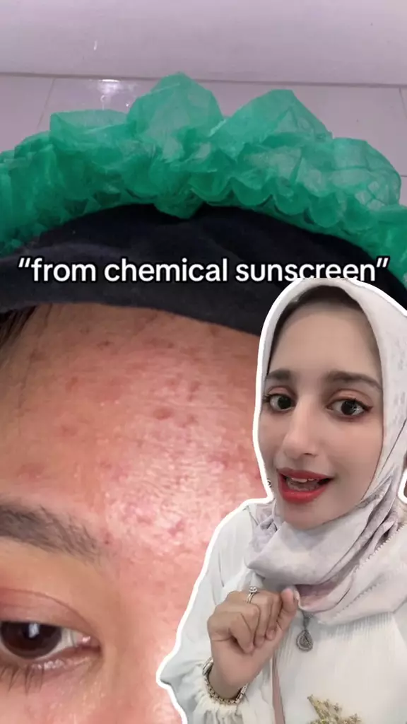 perbedaan chemical dan physical sunscreen. berbagai sumber perbedaan chemical dan physical sunscreen. berbagai sumber