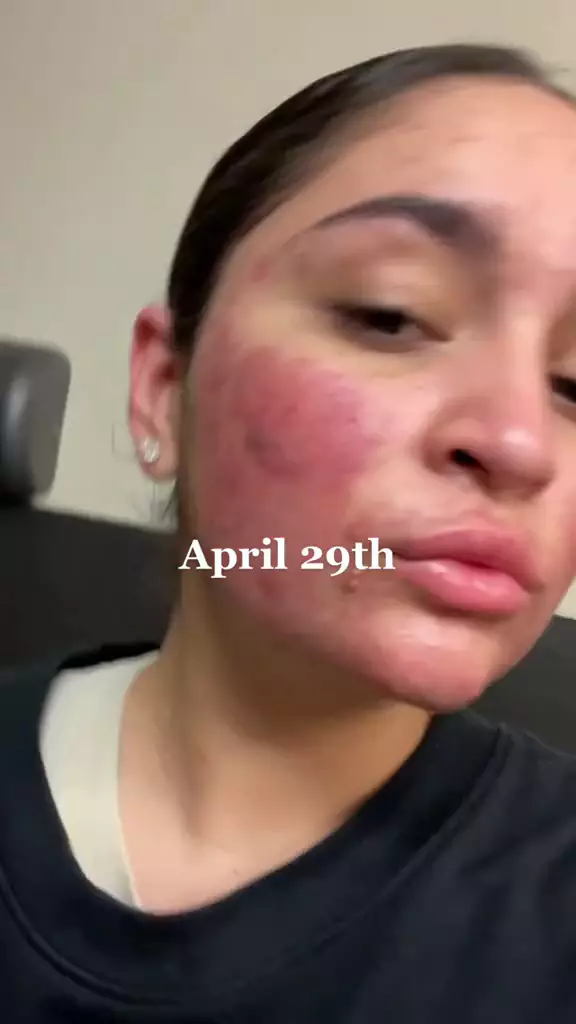 Perjuangan cewek sembuh dari jerawat  berbagai sumber