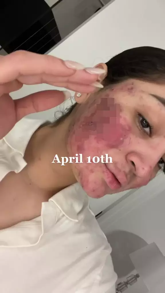 Perjuangan cewek sembuh dari jerawat © 2024 TikTok