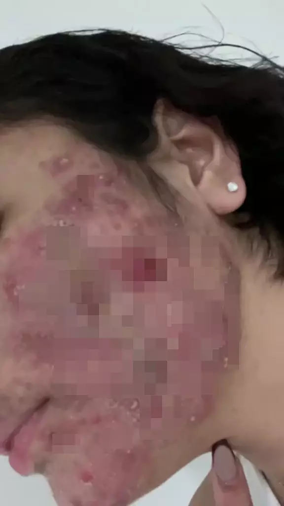 Perjuangan cewek sembuh dari jerawat © 2024 TikTok