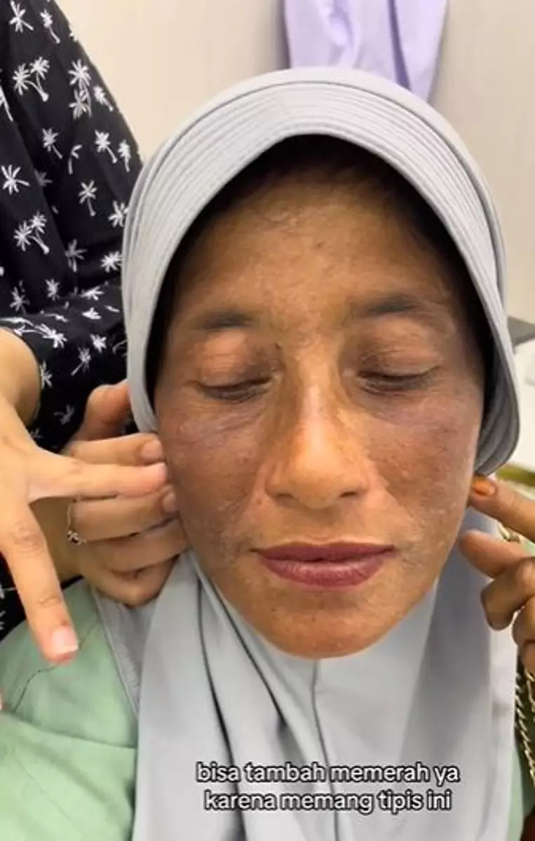 Kisah emak-emak pengen punya wajah glowing ini malah berakhir gosong TikTok Kisah emak-emak pengen punya wajah glowing ini malah berakhir gosong TikTok