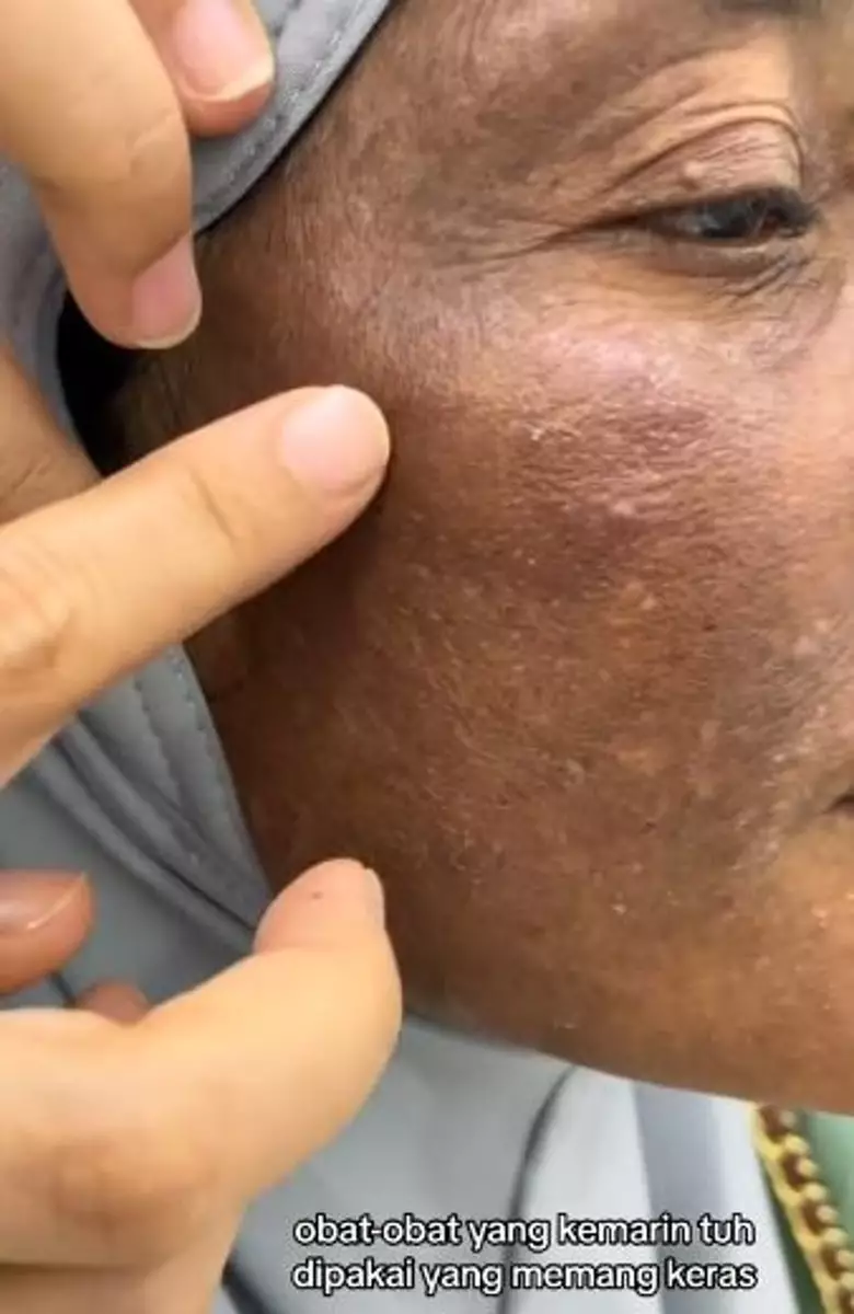 Kisah emak-emak pengen punya wajah glowing ini malah berakhir gosong TikTok Kisah emak-emak pengen punya wajah glowing ini malah berakhir gosong TikTok