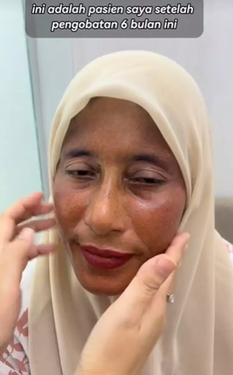 Kisah emak-emak pengen punya wajah glowing ini malah berakhir gosong TikTok Kisah emak-emak pengen punya wajah glowing ini malah berakhir gosong TikTok