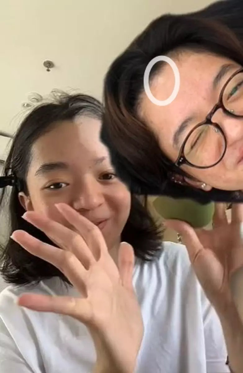 Kisah cewek alami vitiligo usai bleaching rambut TikTok