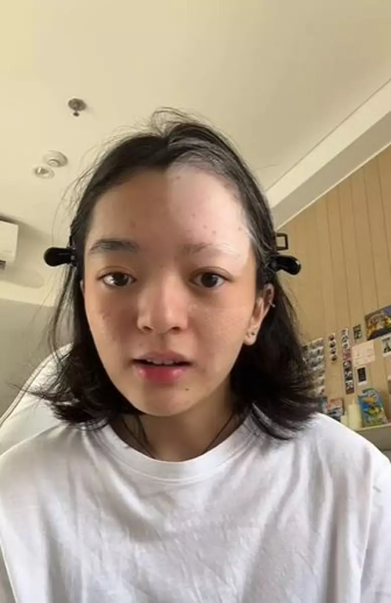 Kisah cewek alami vitiligo usai bleaching rambut TikTok