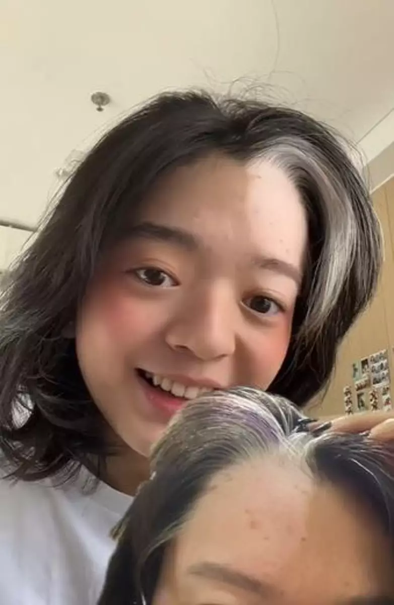 Kisah cewek alami vitiligo usai bleaching rambut TikTok