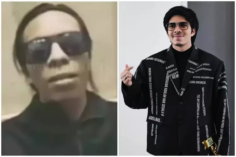 Potret Atta Halilintar sebelum & sesudah rutin treatment Berbagai sumber