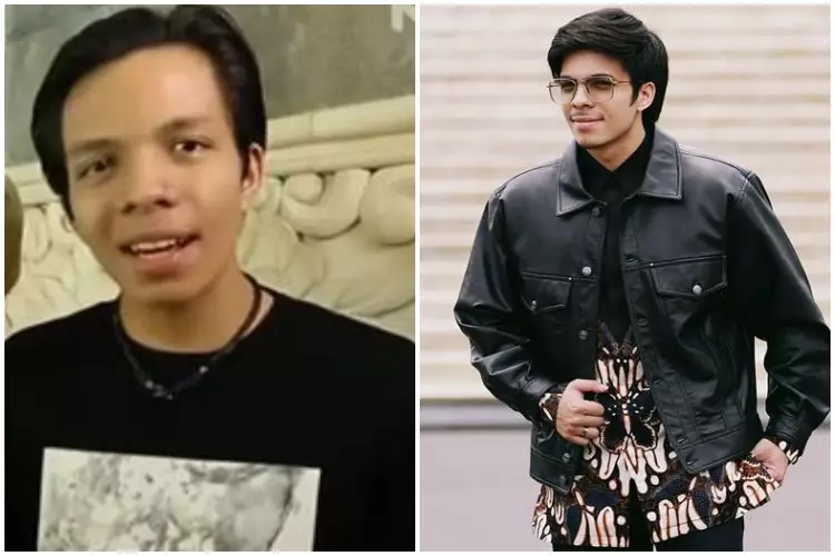 Potret Atta Halilintar sebelum & sesudah rutin treatment Berbagai sumber