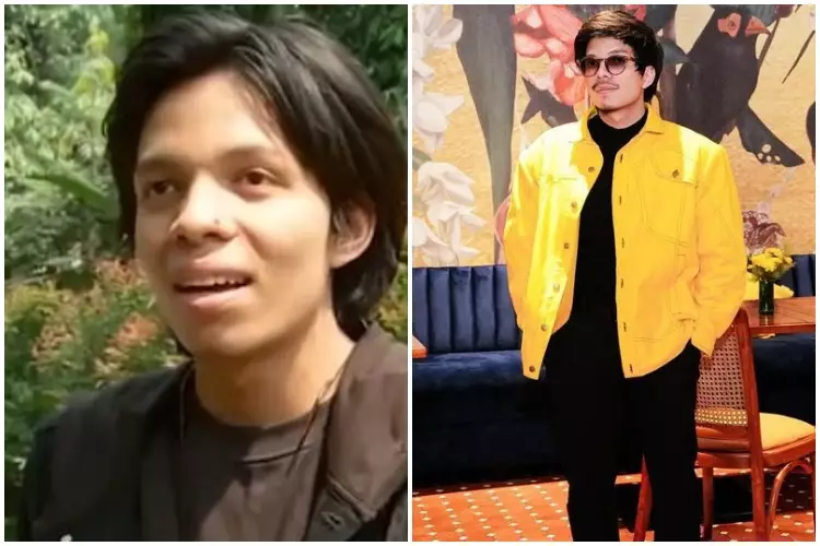 Potret Atta Halilintar sebelum & sesudah rutin treatment Berbagai sumber