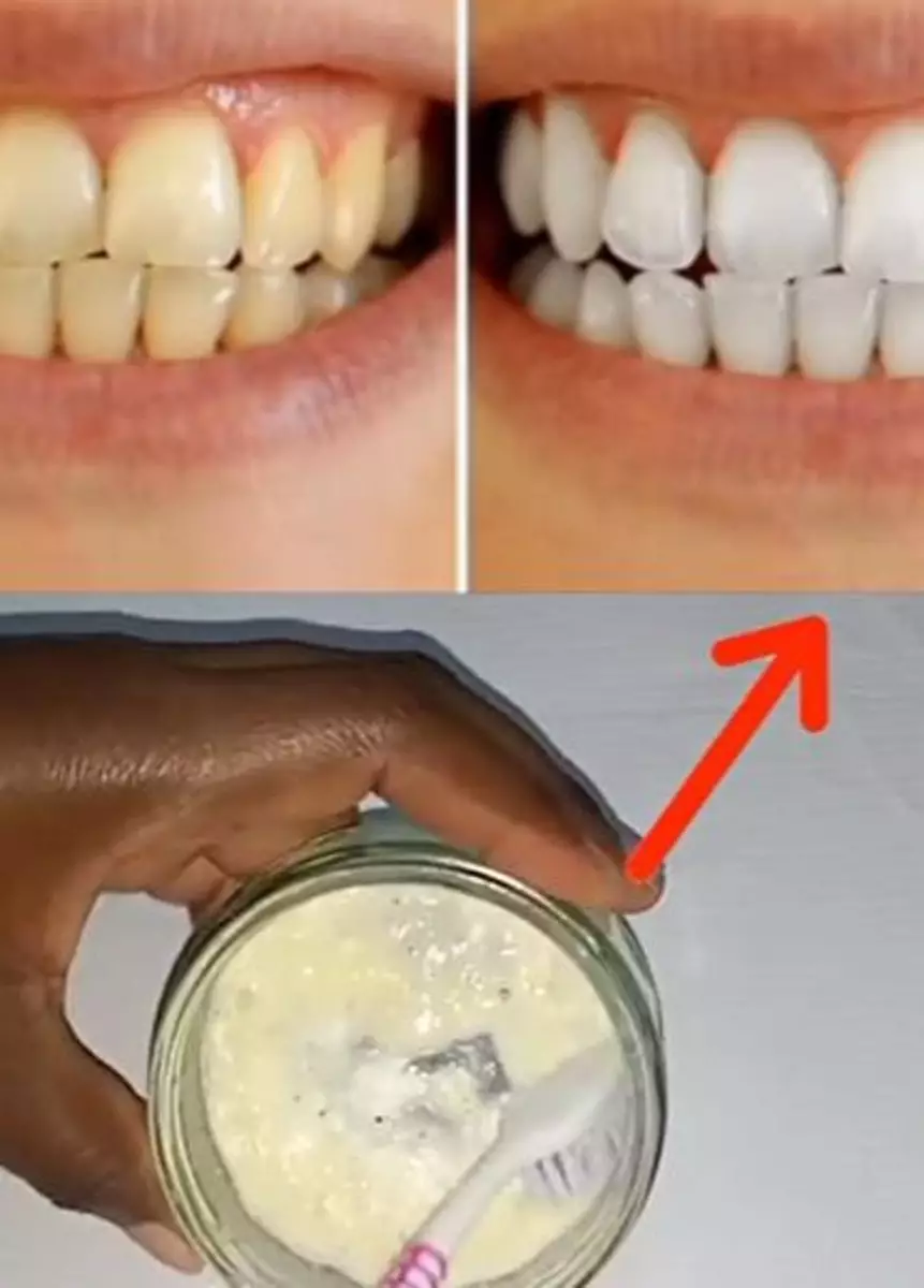 Atasi gigi berkerak kuning cuma pakai 2 jenis buah Berbagai sumber Atasi gigi berkerak kuning cuma pakai 2 jenis buah Berbagai sumber