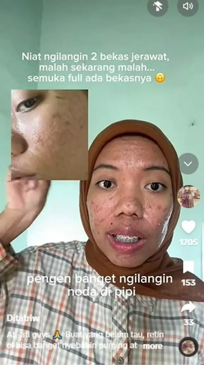 Kisah cewek breakout setelah pakai retinol TikTok