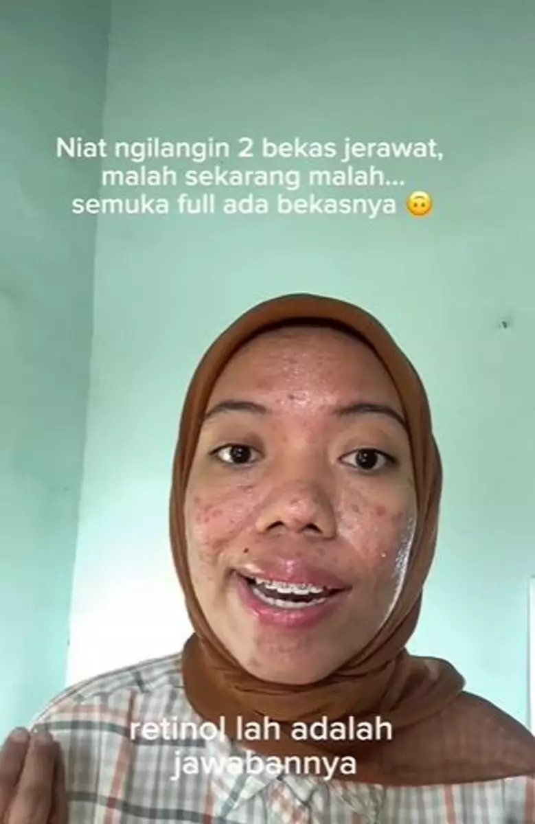 Kisah cewek breakout setelah pakai retinol TikTok