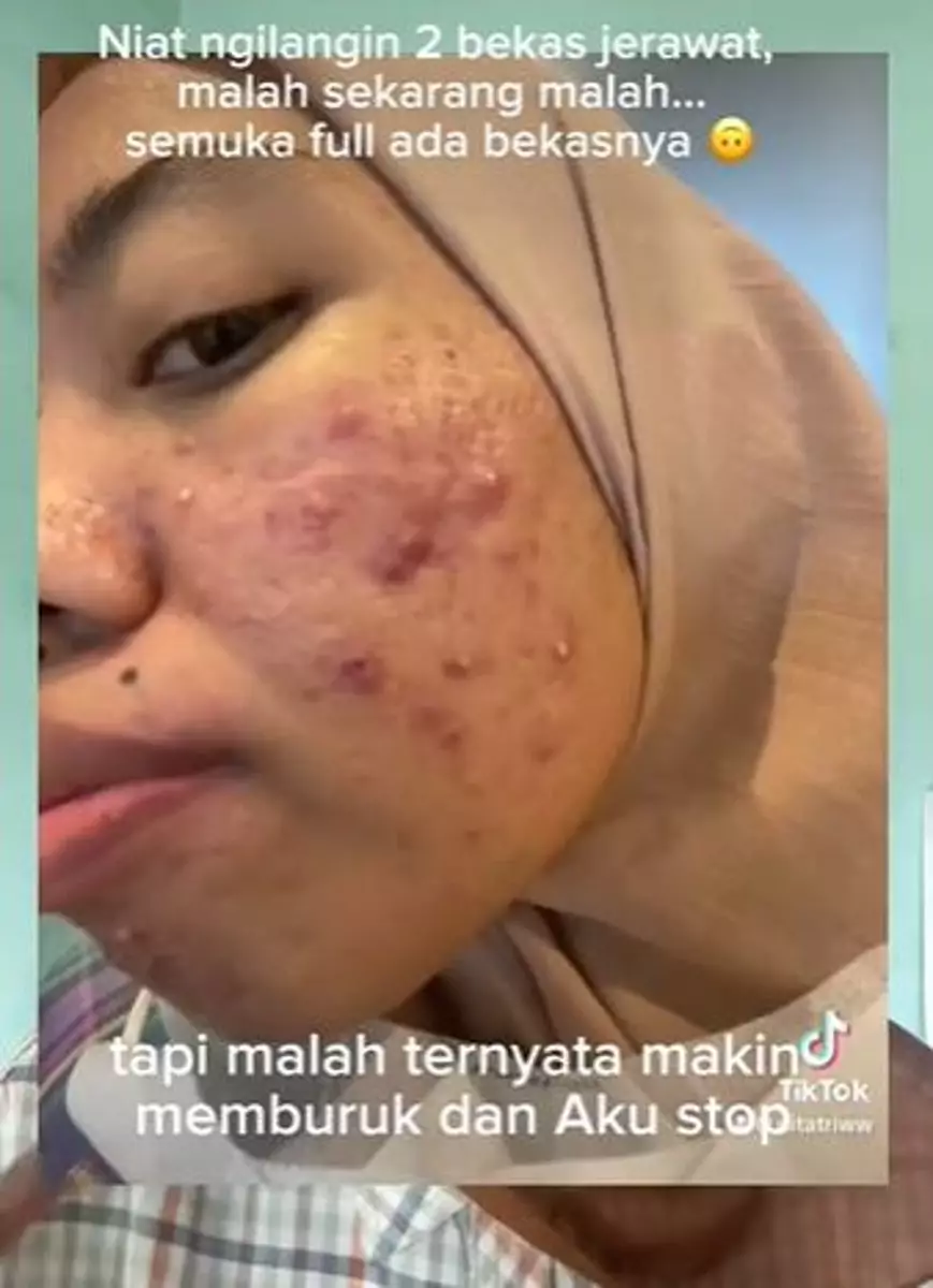 Kisah cewek breakout setelah pakai retinol TikTok