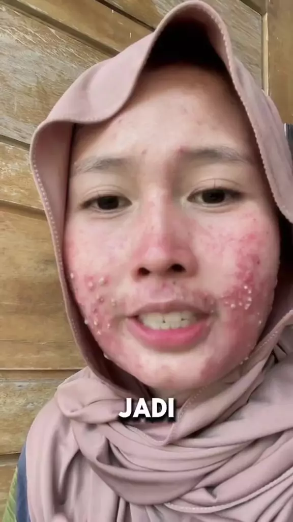 wanita ini bagikan perjuang atasi jerawat berbagai sumber