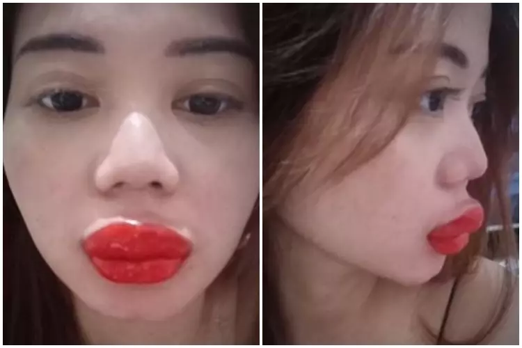Hasil sulam bibir cewek ini malah bak disengat tawon TikTok Hasil sulam bibir cewek ini malah bak disengat tawon TikTok