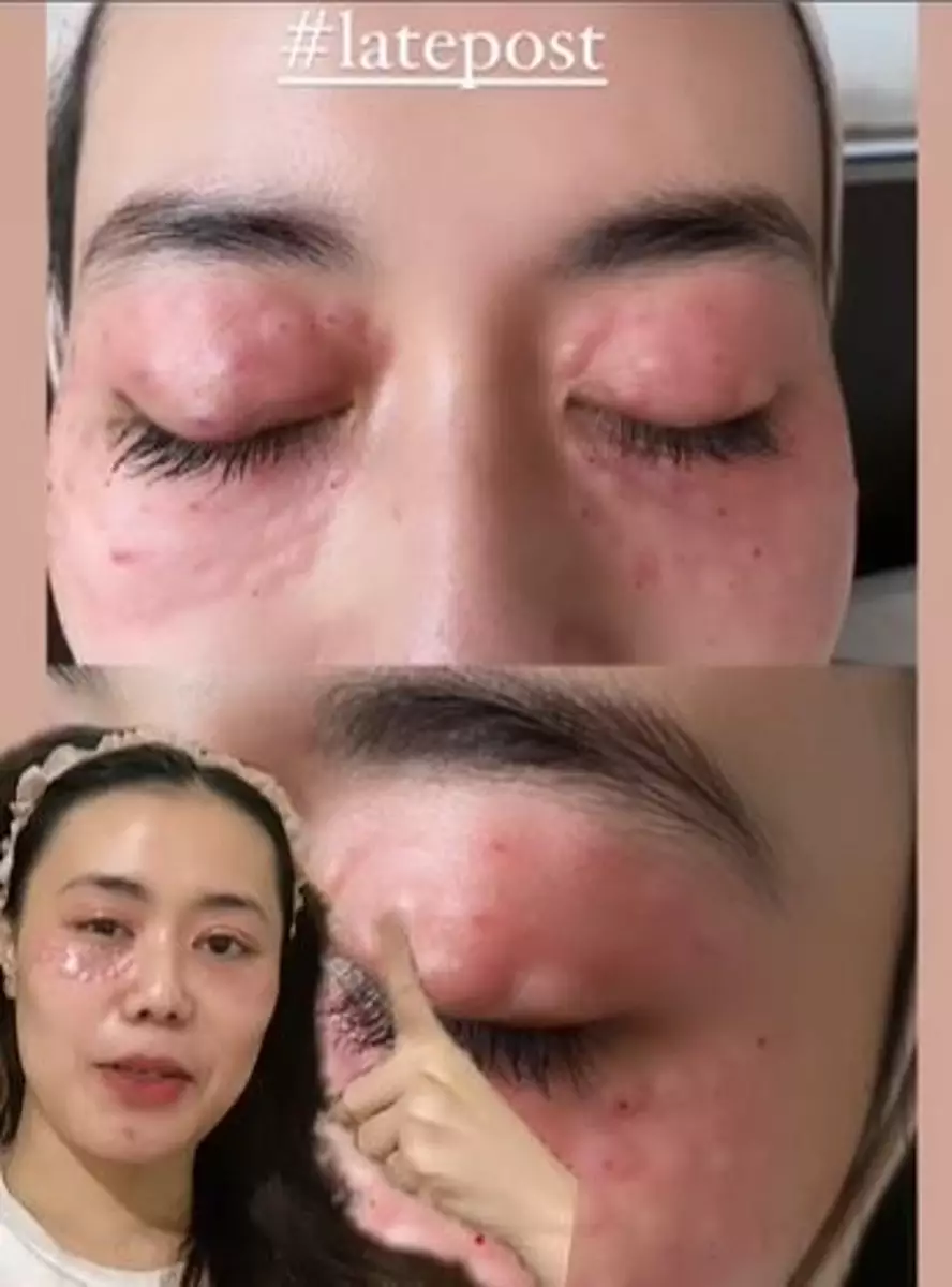 Lakukan treatment hilangkan mata panda malah berakhir iritasi TikTok Lakukan treatment hilangkan mata panda malah berakhir iritasi TikTok