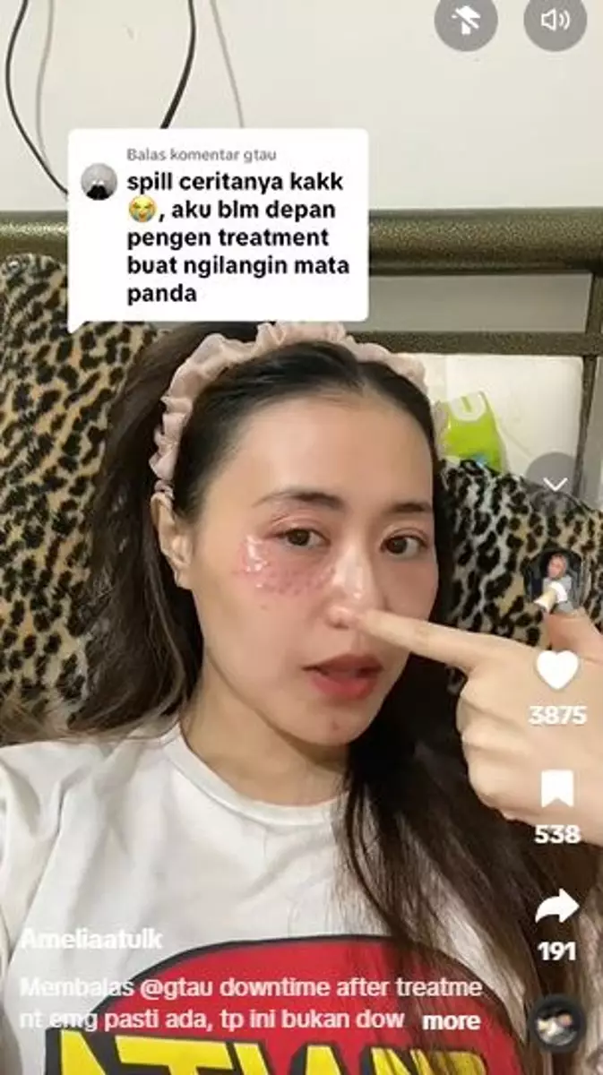 Lakukan treatment hilangkan mata panda malah berakhir iritasi TikTok Lakukan treatment hilangkan mata panda malah berakhir iritasi TikTok