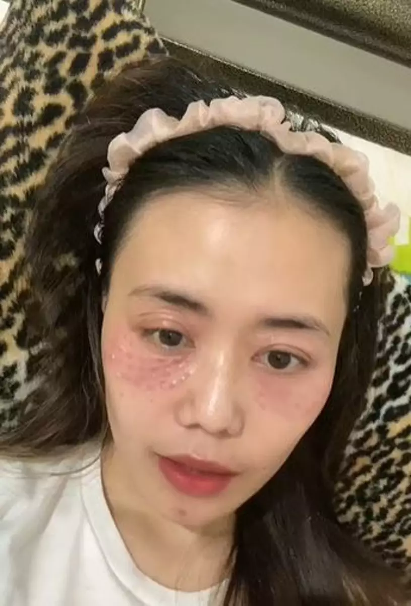 Lakukan treatment hilangkan mata panda malah berakhir iritasi TikTok Lakukan treatment hilangkan mata panda malah berakhir iritasi TikTok