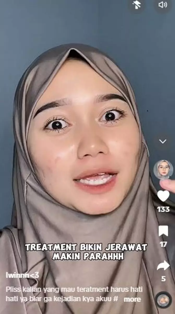 Kisah cewek lakukan Dermapen kedua kali malah berakhir nyesek TikTok