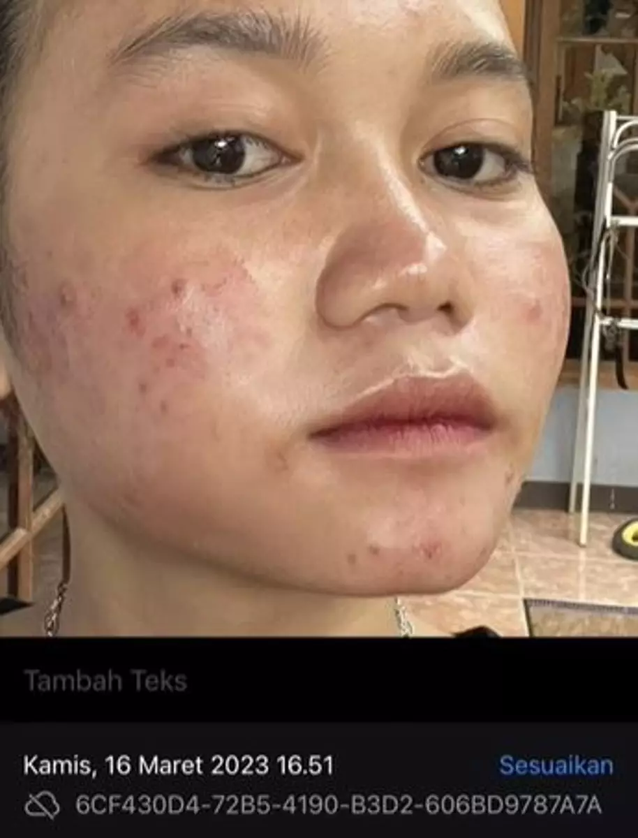 Kisah cewek lakukan Dermapen kedua kali malah berakhir nyesek TikTok