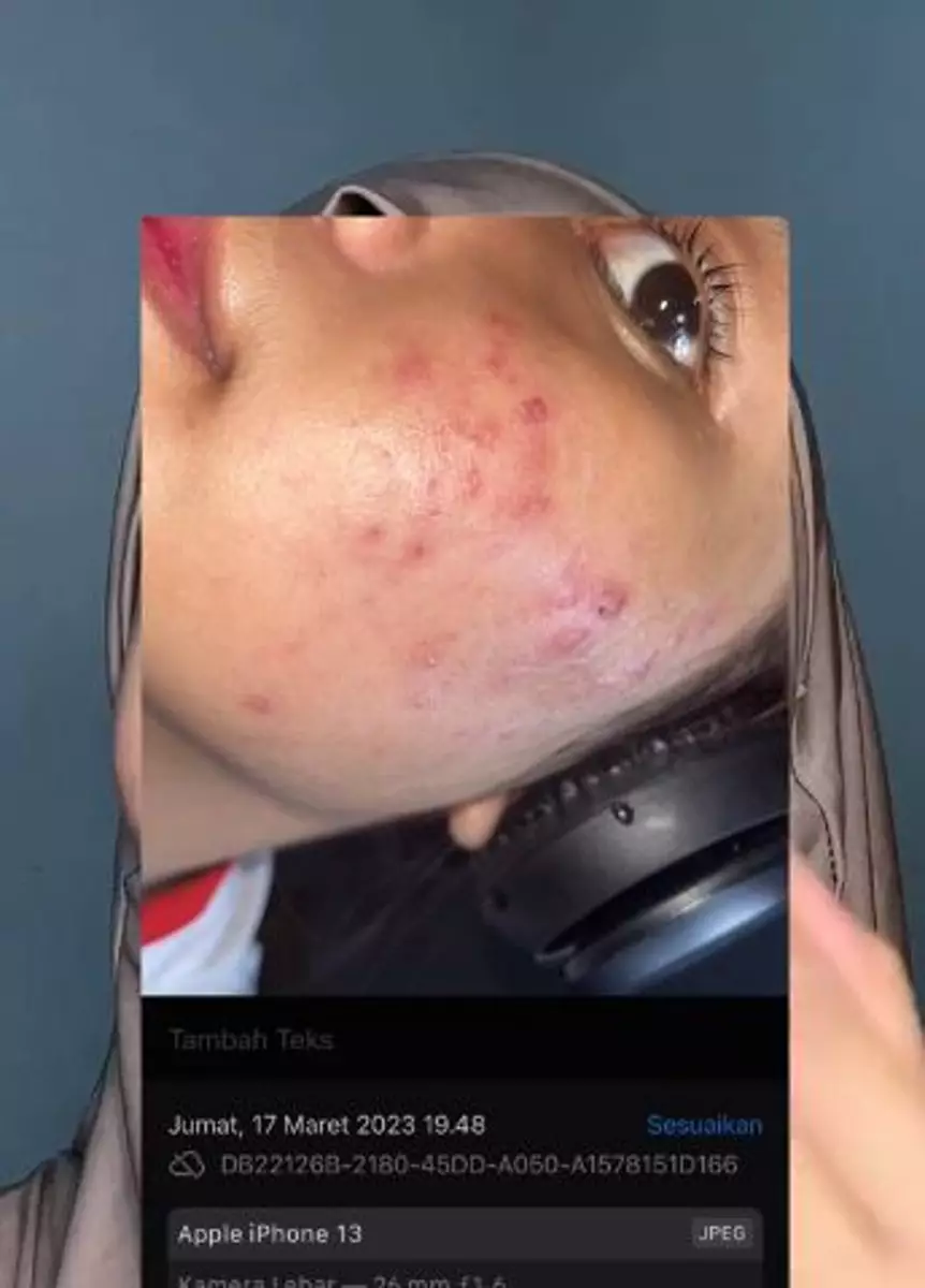 Kisah cewek lakukan Dermapen kedua kali malah berakhir nyesek TikTok