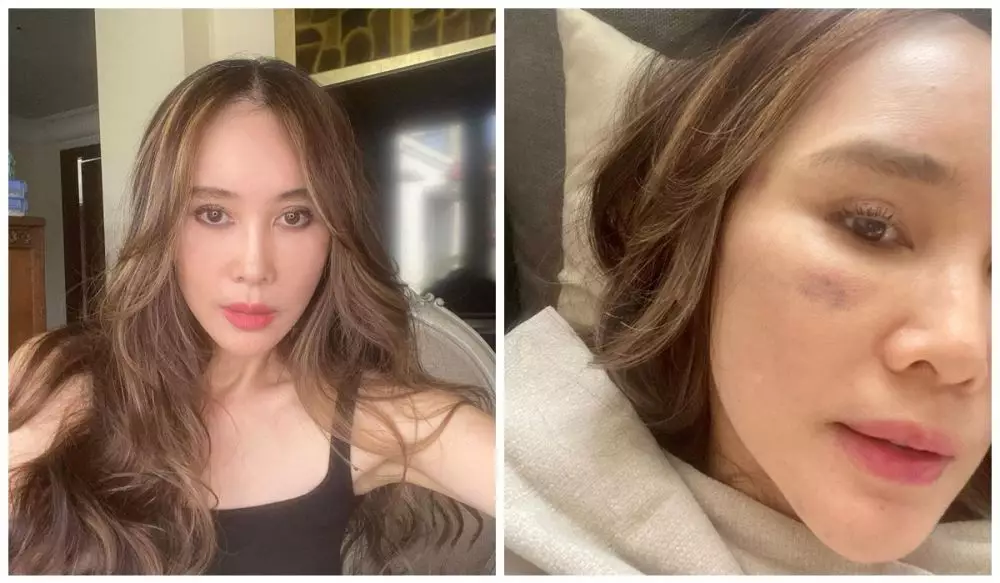 Ina Thomas operasi plastik berbagai sumber