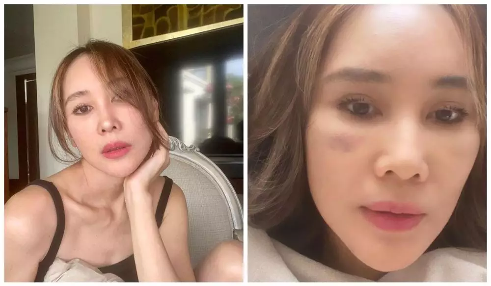 Ina Thomas operasi plastik berbagai sumber