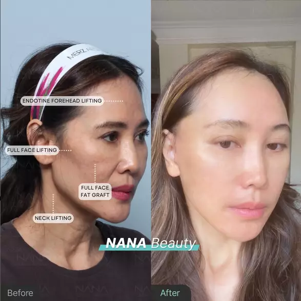 Ina Thomas operasi plastik berbagai sumber