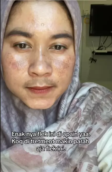 Wajah penuh flek hitam akibat hormon hamil berbagai sumber Wajah penuh flek hitam akibat hormon hamil berbagai sumber