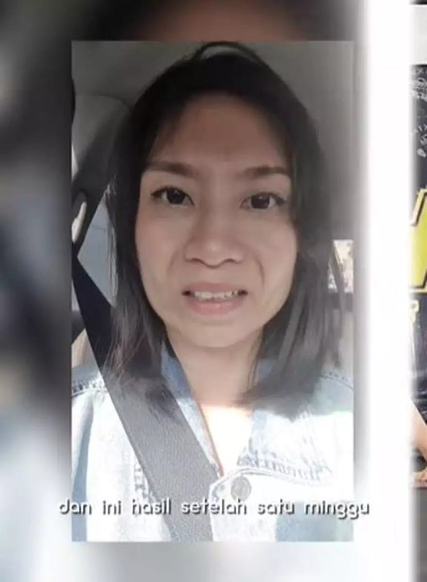 Treatment botoks biar cantik malah wajah kaku dan nggak bisa senyum TikTok