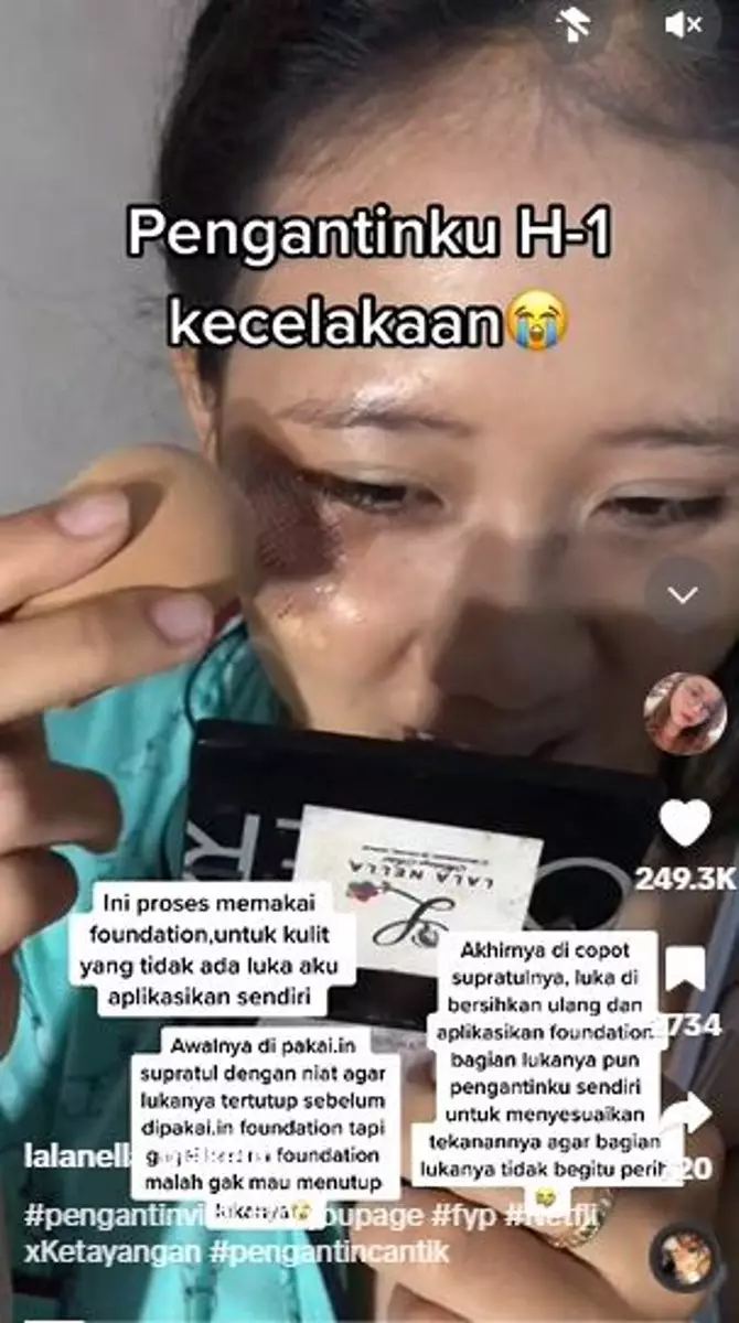 Alami kecelakaan H-1 menikah bikin wajah luka  TikTok