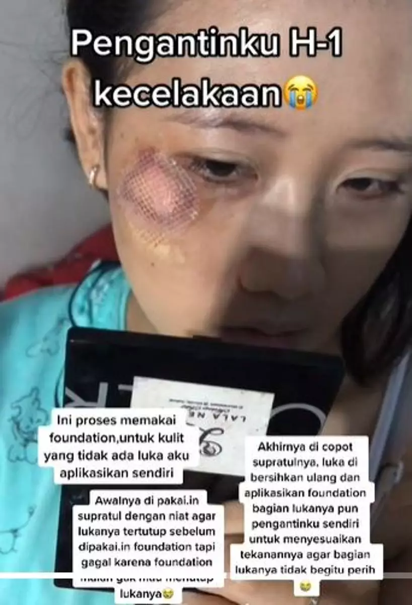 Alami kecelakaan H-1 menikah bikin wajah luka  TikTok