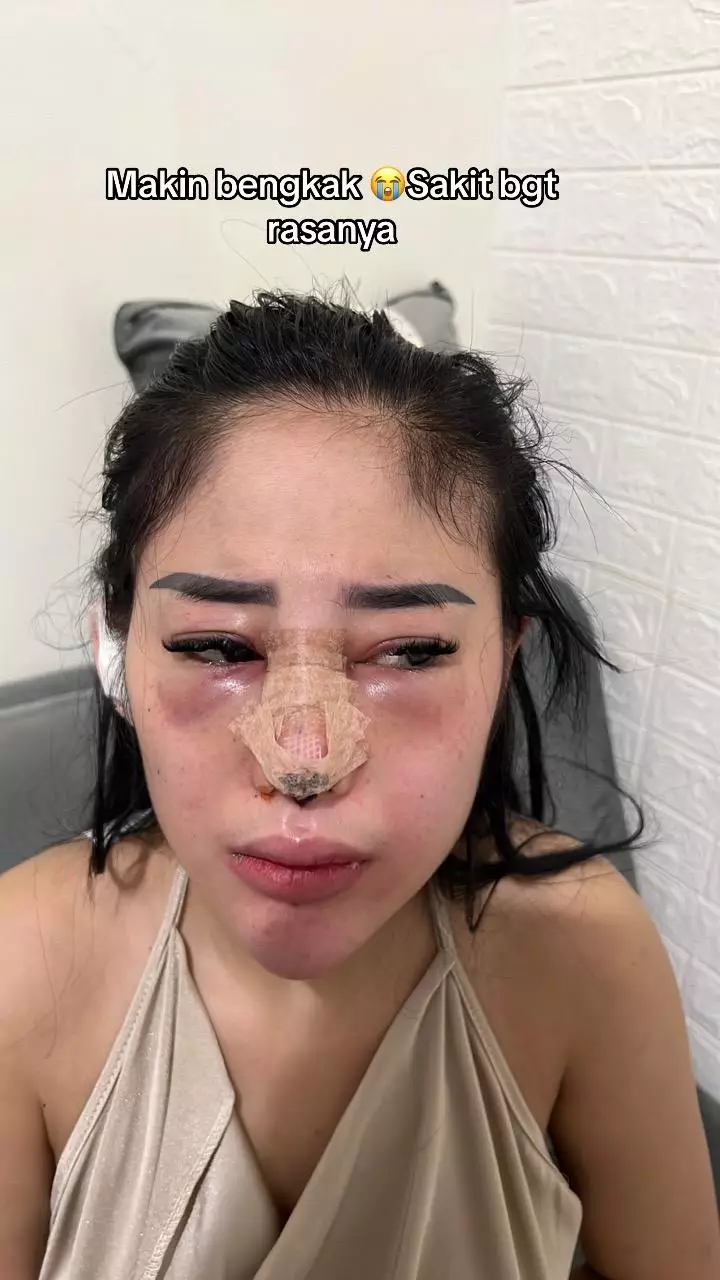 Kisah cewek gagal operasi hidung © 2024 TikTok